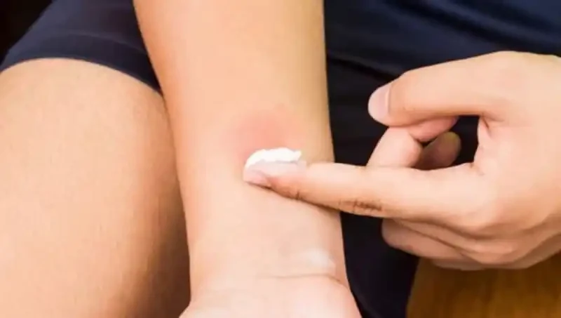 Behandlung Von Insektenstichen