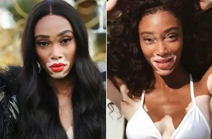 Winnie Harlow