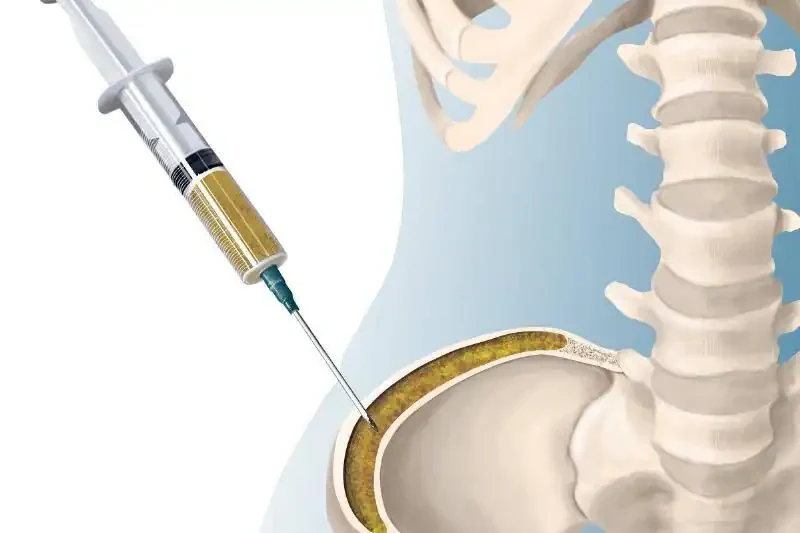 What Is A Bone Marrow Transplant